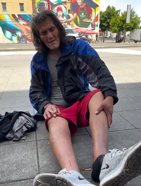 Help Us Fund Medical Treatment And Recovery For Severe Leg Edema