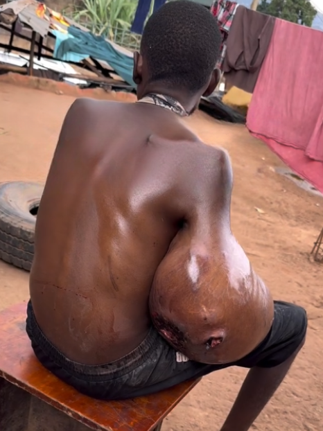 Let's Help Joseph Get The Life Saving Surgery He Needs To Remove This Growth
