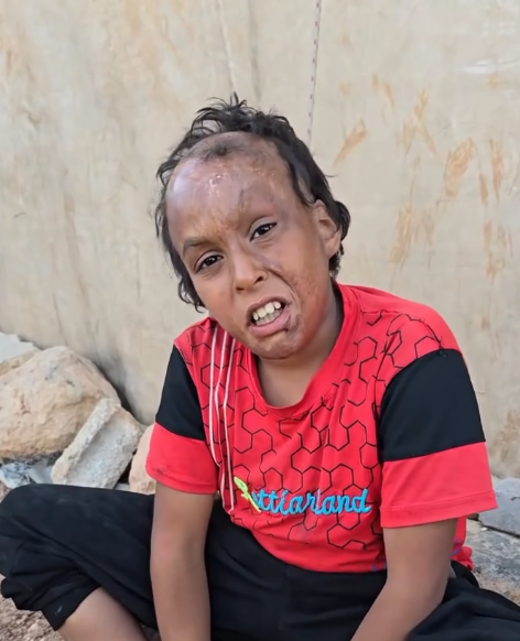 Let's Support Life Changing Reconstructive Surgery For This Young Burn Survivor